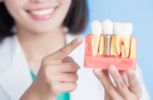 السن التعويضي