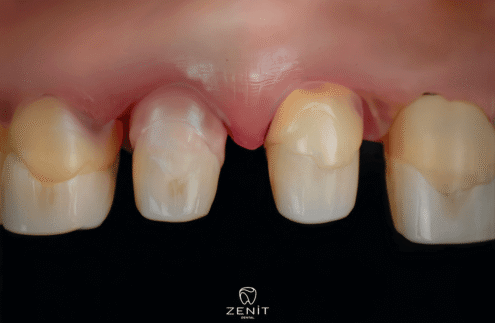 Diş Kesimi Sonrası Şiddetli Ağrı