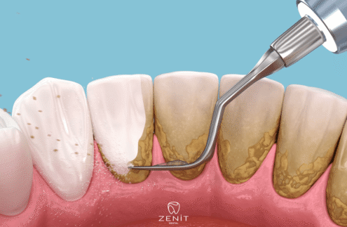 Diş Taşı Temizliği Zararlı Mı