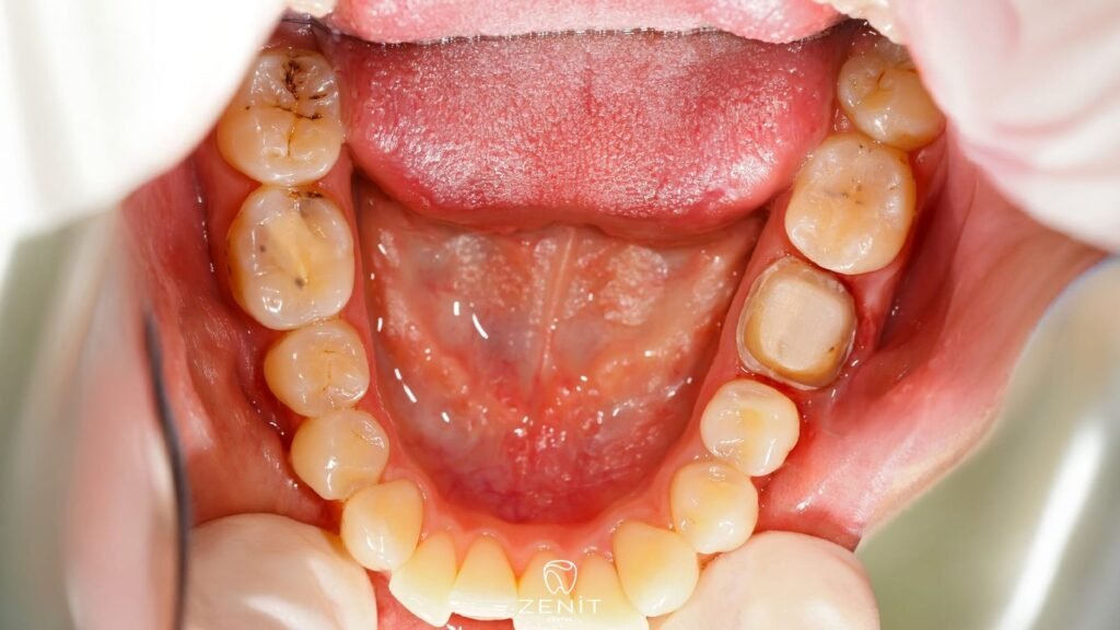 Dişlerimiz Neden Çürür