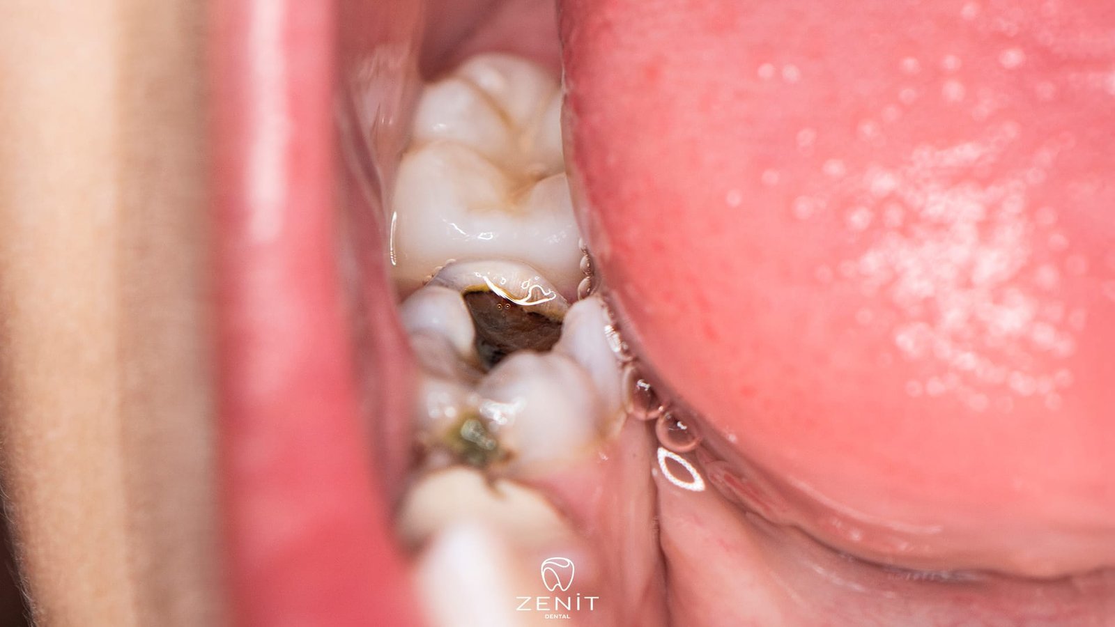 Dişlerimiz Neden Çürür