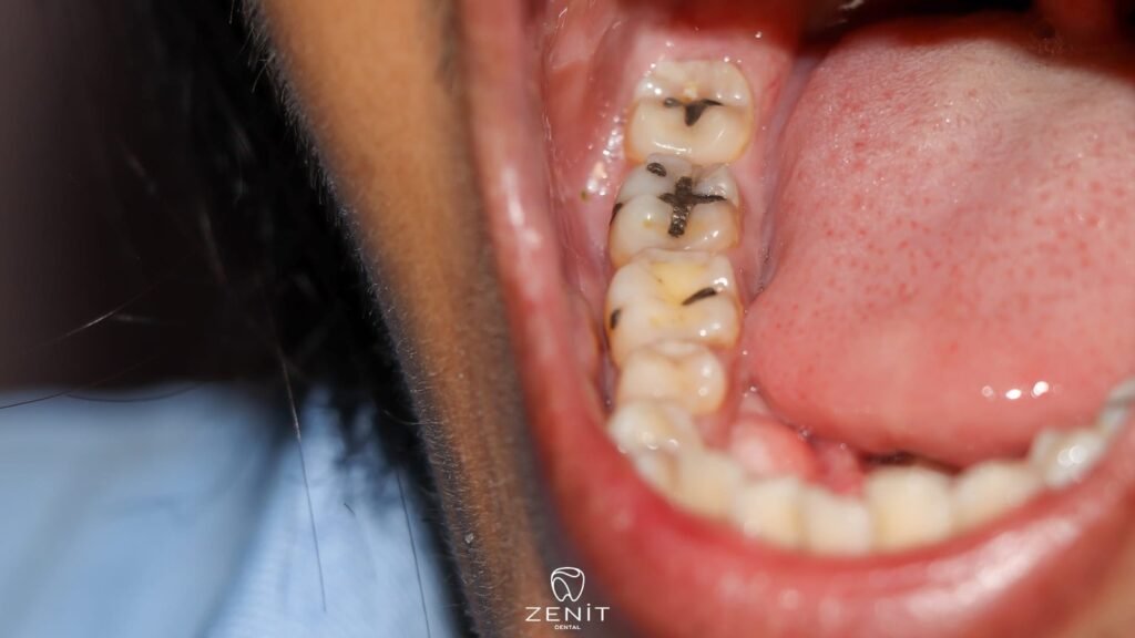 Dişlerimiz Neden Çürür